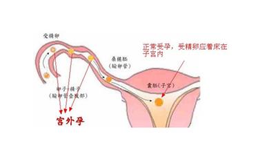 输卵管妊娠威胁生命_鉴别宫外孕很重要